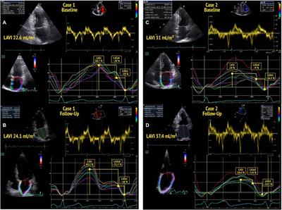 Phasic left atrial strain to predict worsening of diastolic function: Results from the prospective Berlin Female Risk Evaluation follow-up trial